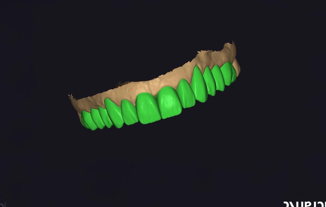 Enceramento diagnóstico digital - arcada anterior no Exocad